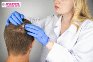 Medical illustration of immune system attacking hair follicles – alopecia areata causes