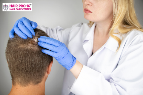 Medical illustration of immune system attacking hair follicles – alopecia areata causes